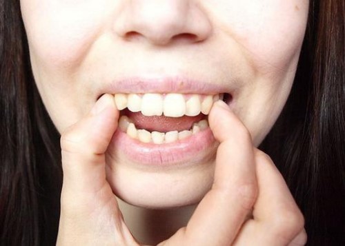 Cách làm răng trắng bóng tại nhà mà bạn nhất định phải biết