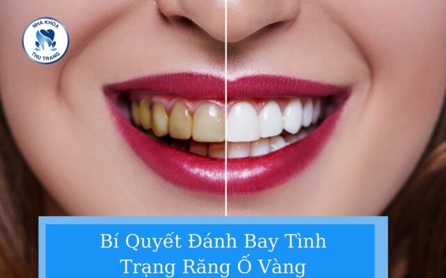 Bí quyết đánh bay tình trạng răng ố vàng
