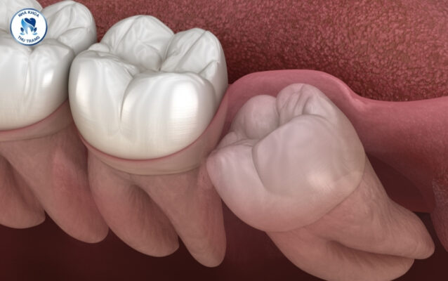 Răng khôn gây viêm lợi