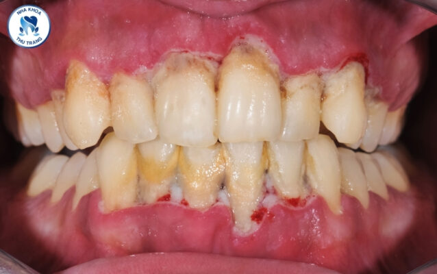 Viêm nha chu là gì?