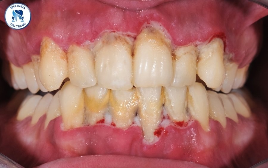 Viêm nha chu là gì?