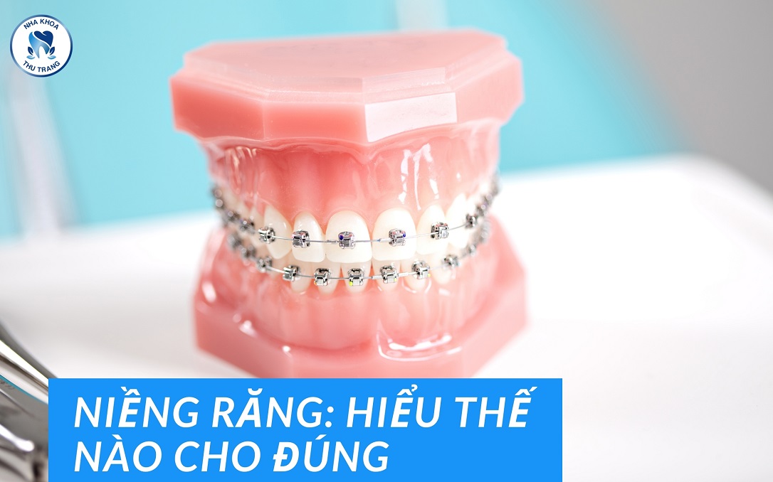 niềng răng; hiểu thế nào cho đúng