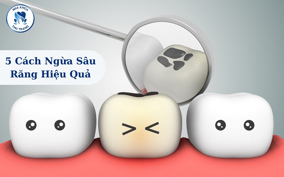 5 cách ngừa sâu răng hiệu quả