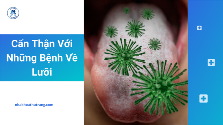 Cẩn thận với những bệnh về lưỡi