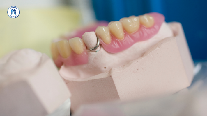 Làm răng giả thay cho răng đã mất