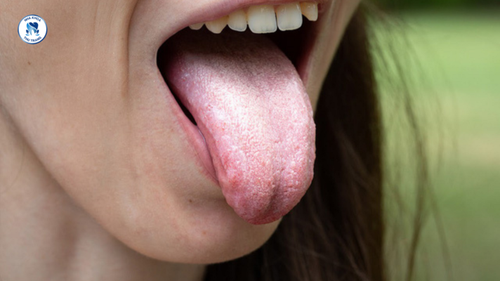 Lưỡi có màu trắng đục