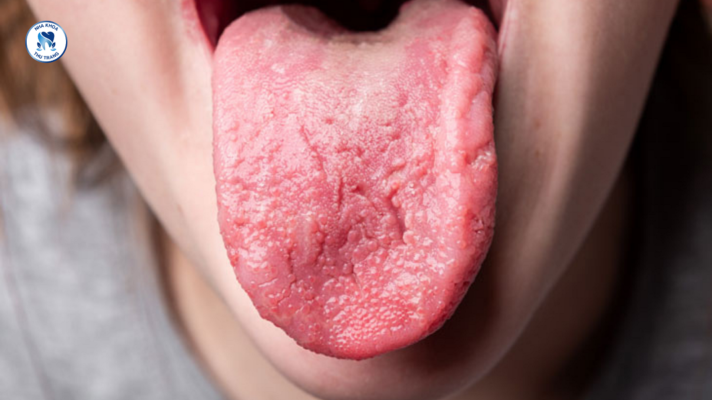 Lưỡi có màu đỏ, sưng hoặc tấy