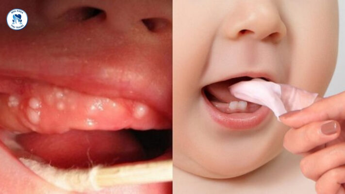 Nanh sữa ở trẻ sơ sinh