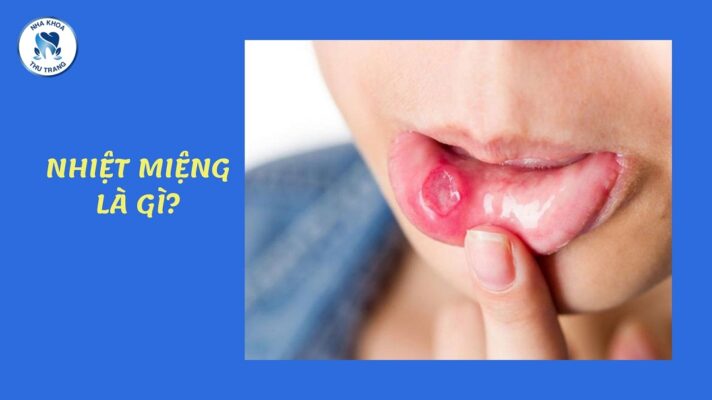 Bệnh nhiệt miệng là gì?
