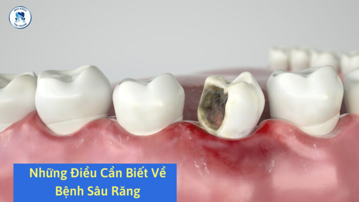 Những điều cần biết về bệnh sâu răng