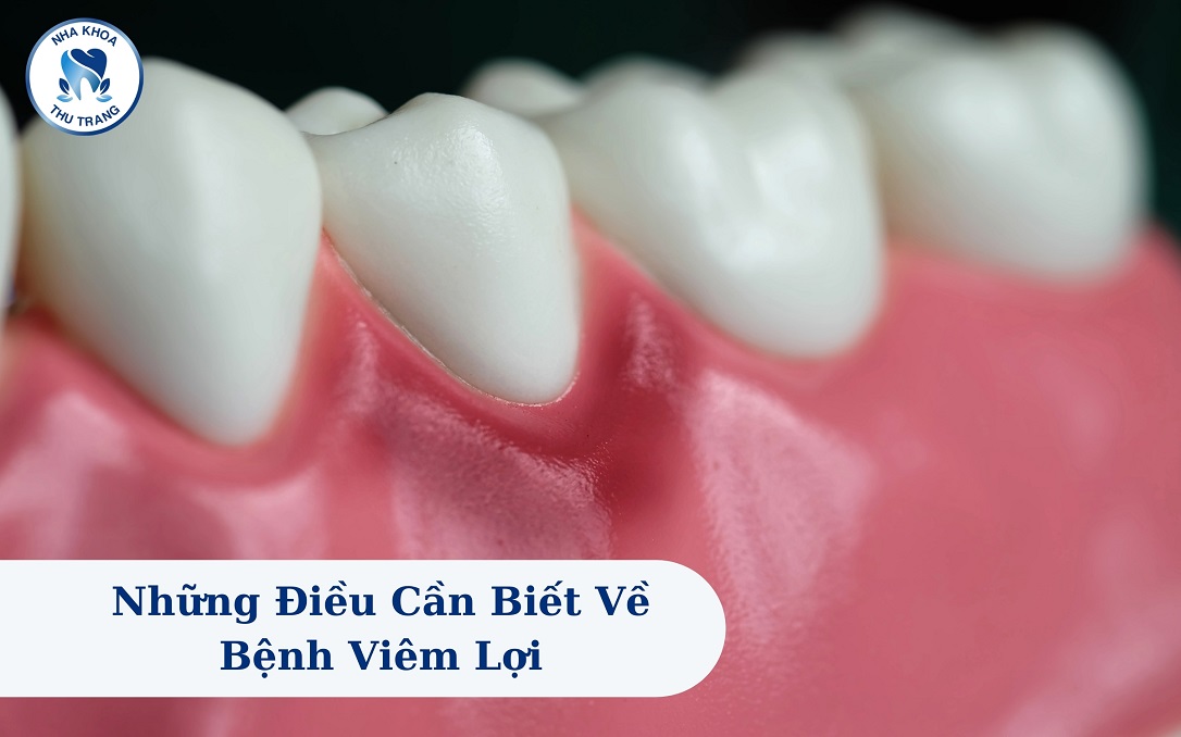 Những điều cần biết về bệnh viêm lợi