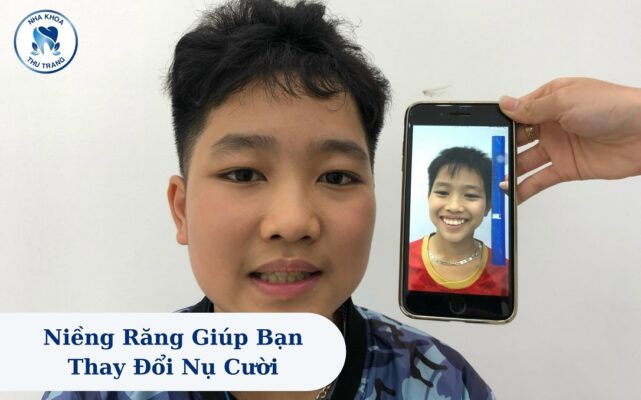 Niềng răng giúp bạn thay đổi nụ cười
