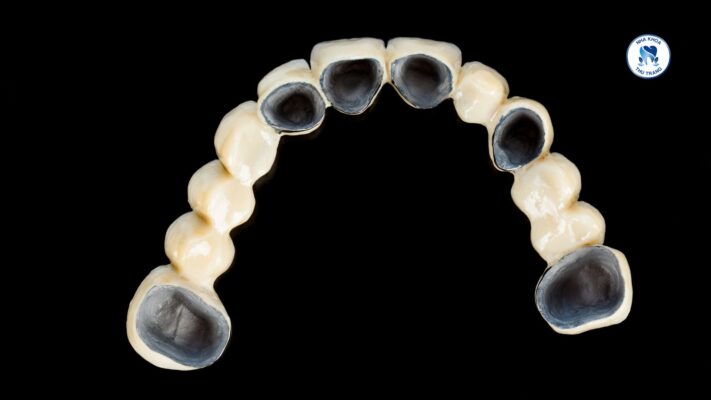 Răng sứ không kim loại thường có đường viền màu đen khi có ánh đèn chiếu vào