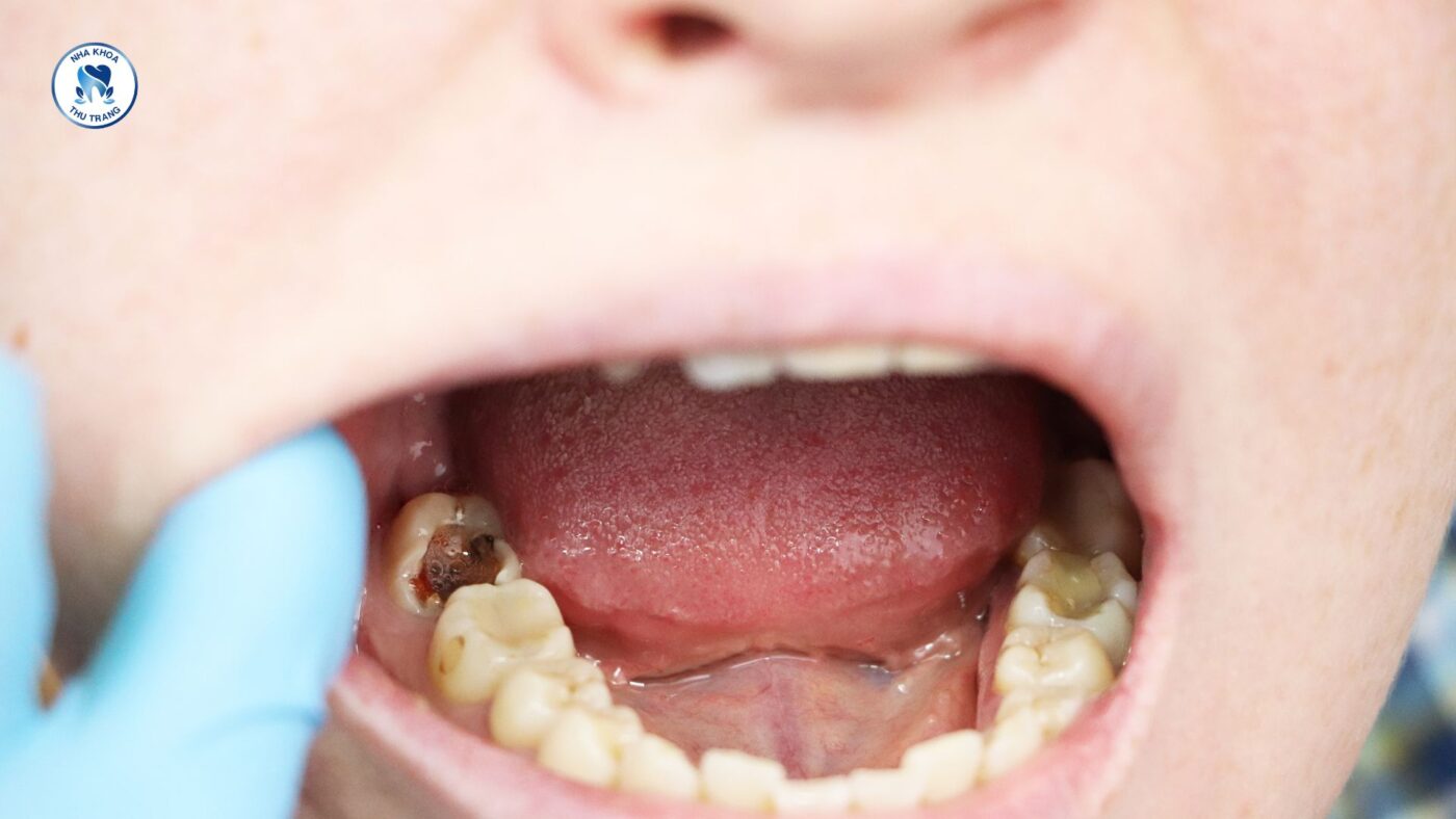 Sâu răng - mòn men răng