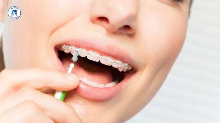 Sử dụng bàn chải kẽ giúp vệ sinh thức ăn trên mắc cài