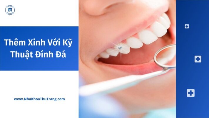 Thêm xinh với kỹ thuật đính đá lên răng