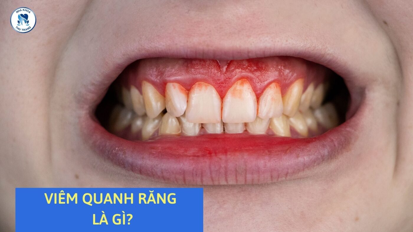 Viêm quanh răng là gì