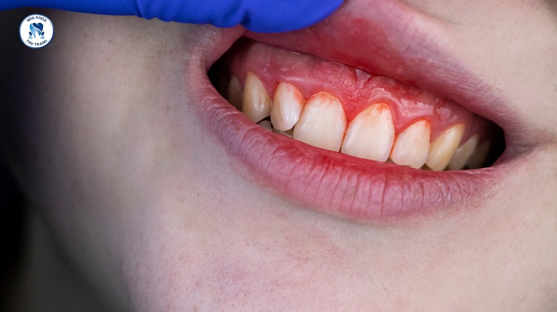 Nguyên Nhân Bị Bệnh Về Răng Miệng