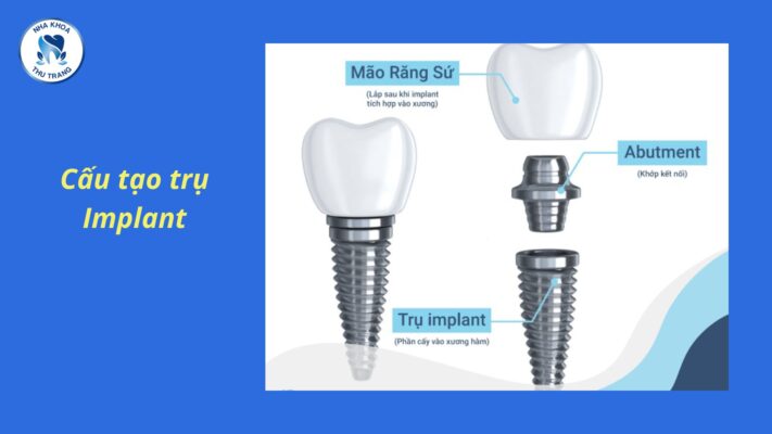 Những lưu ý khi cấy ghép răng implant
