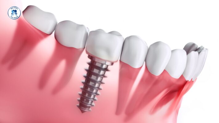Răng implant mang lại nhiều lợi ích cho bạn