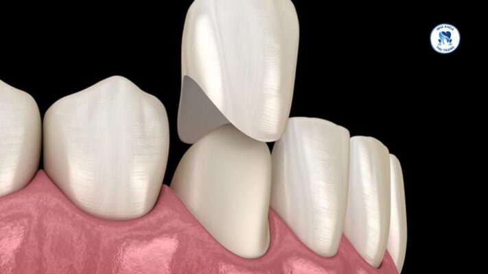 Răng toàn sứ có độ bền cao hơn răng kim loại