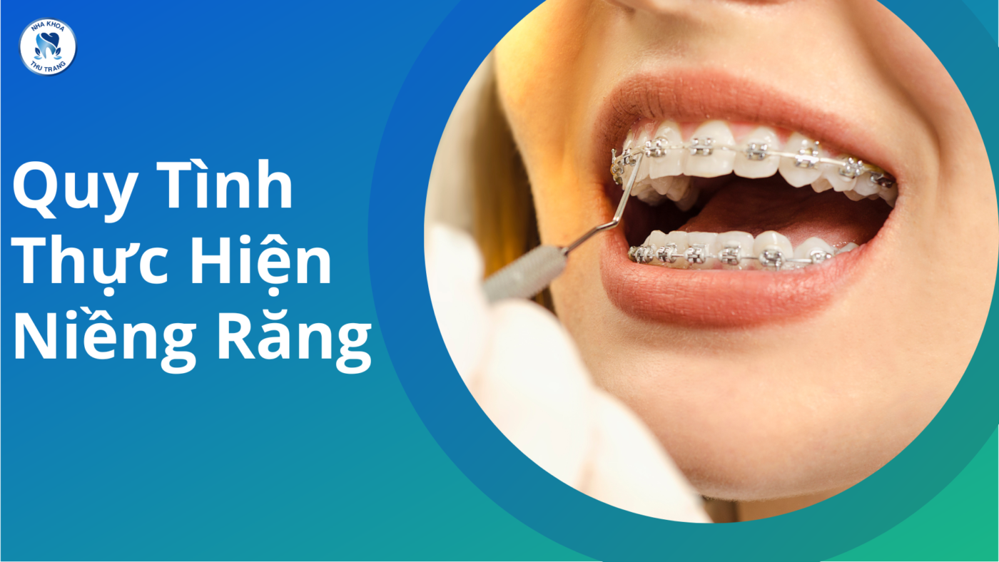 Quy trình niềng răng