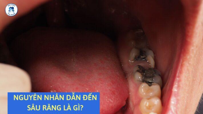 Nguyên nhân dẫn đến sâu răng ở trẻ