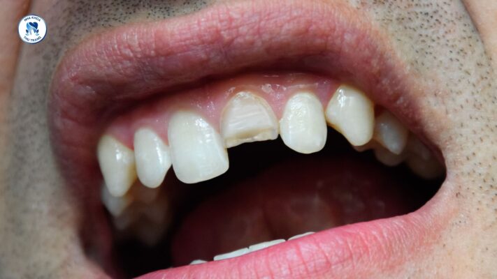 Những trường hợp nào cần bọc răng sứ