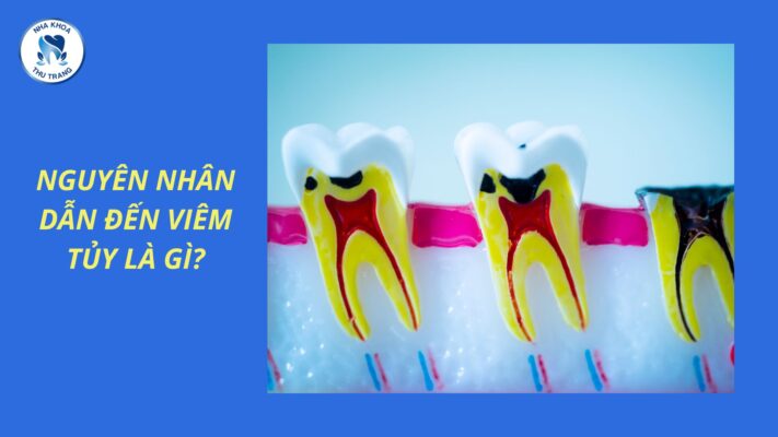 Nguyên nhân dẫn đến Viêm tủy răng là gì?
