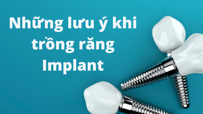 Những lưu ý khi trồng răng Implant