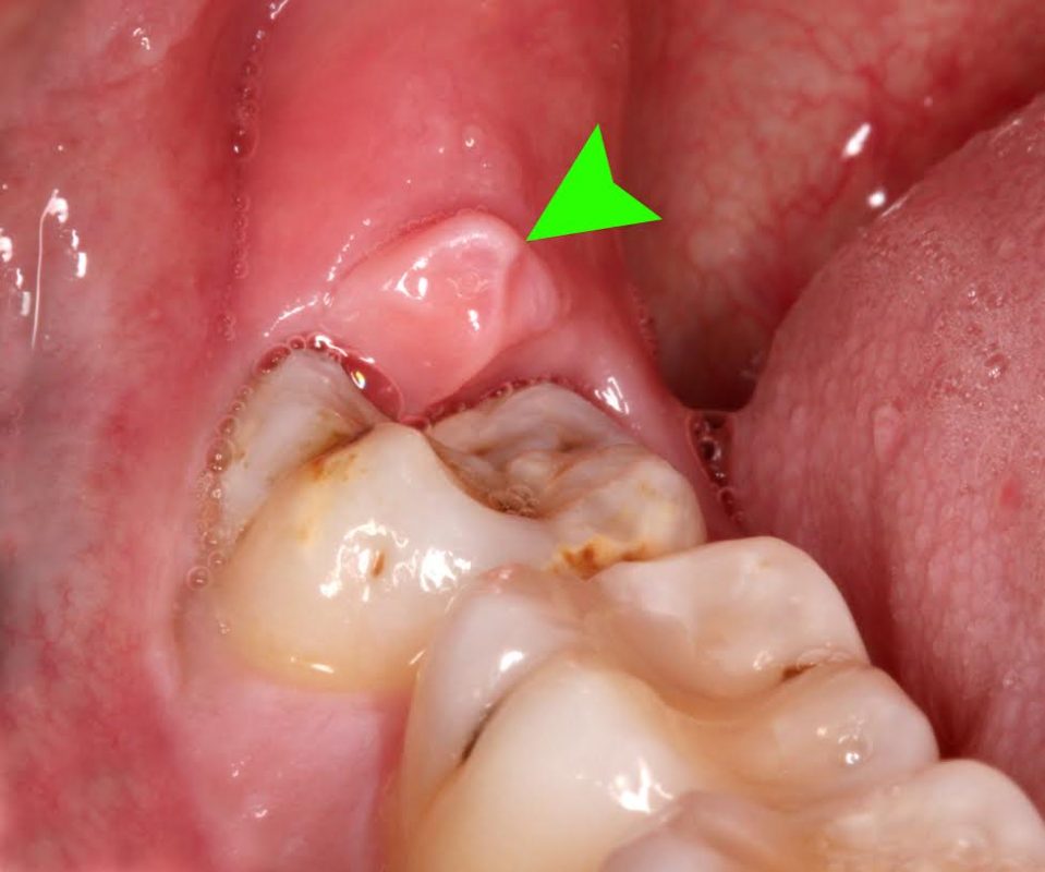Những rắc rối do răng khôn gây ra cho sức khỏe răng miệng