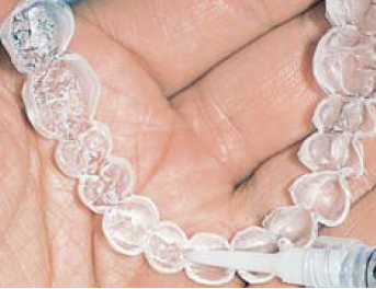 Làm trắng răng tại nhà với Opalescence