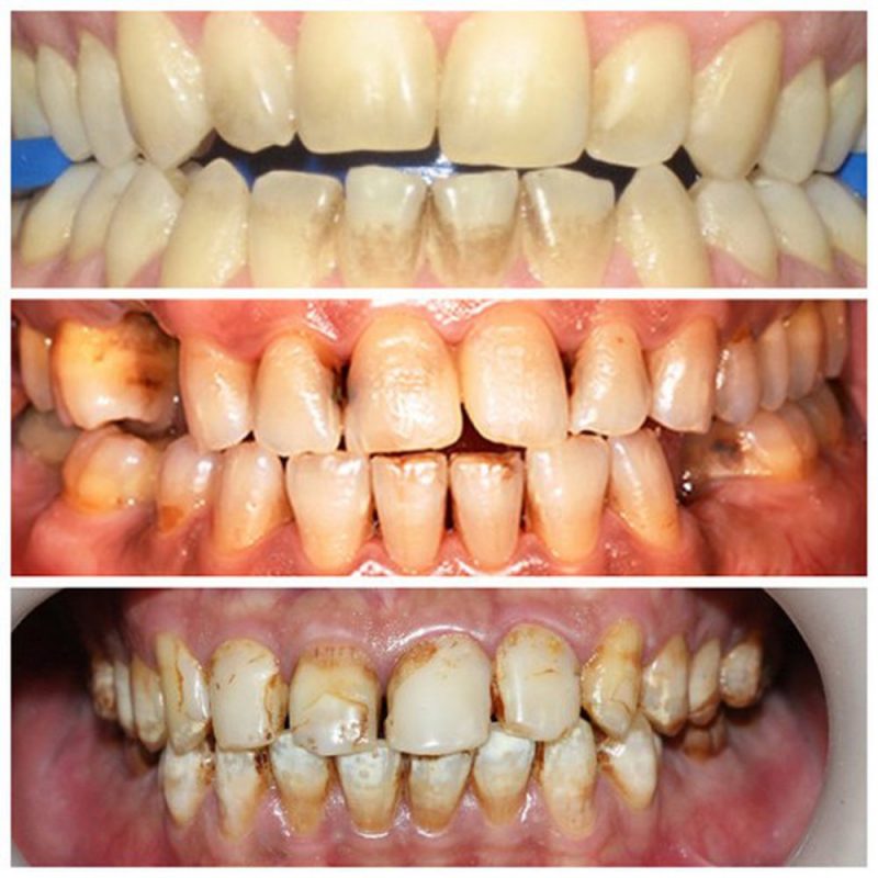 Tác hại của thuốc lá đối với sức khỏe răng miệng