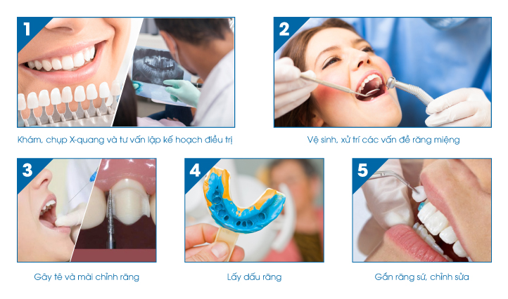 Quy trình dán răng sứ Veneer tại phòng khám nha khoa Thu Trang