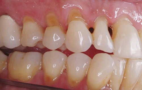 Hở chân răng là gì? Nguyên nhân và cách chữa trị hiệu quả - Phòng Khám Nha Khoa Thu Trang