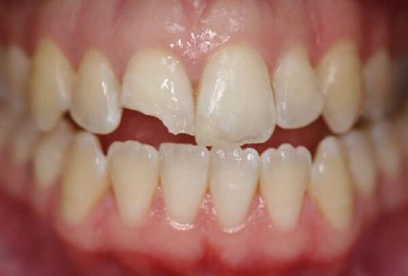 Răng bị sứt mẻ nên chọn bọc răng sứ Cercon