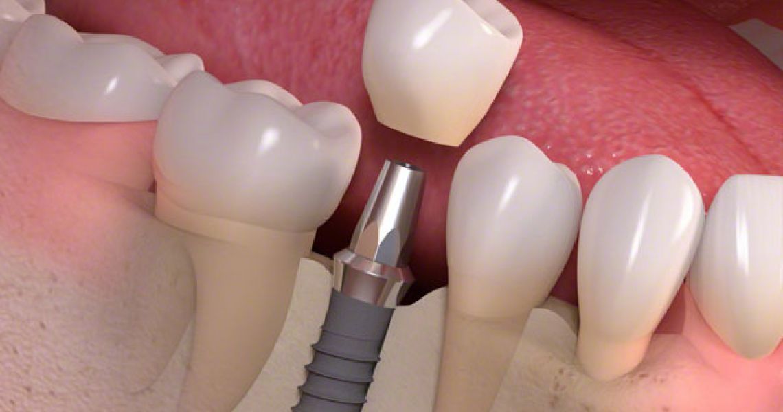 Điều kiện cần có để thực hiện cấy ghép Implant