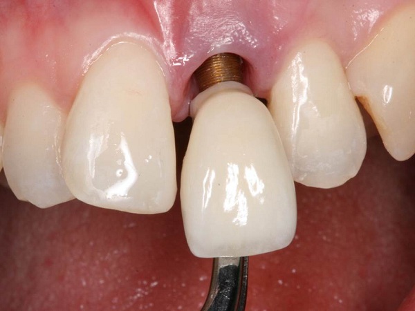 Nguyên nhân khiến răng Implant lung lay