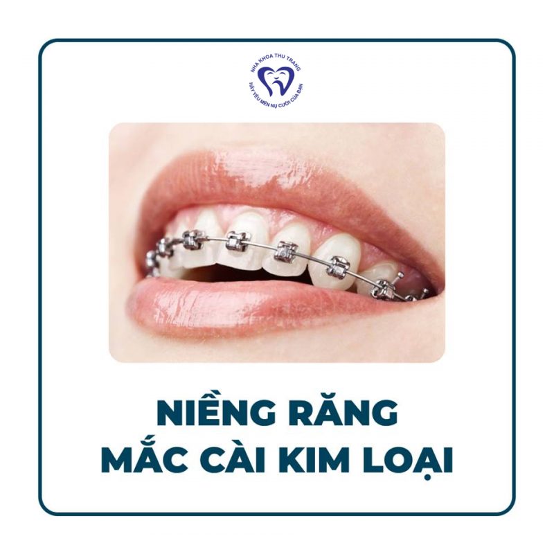 Lựa chọn loại mắc cài nào phù hợp ?