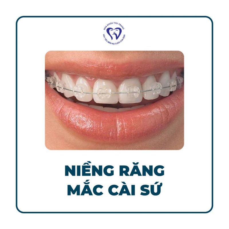 Lựa chọn loại mắc cài nào phù hợp ?