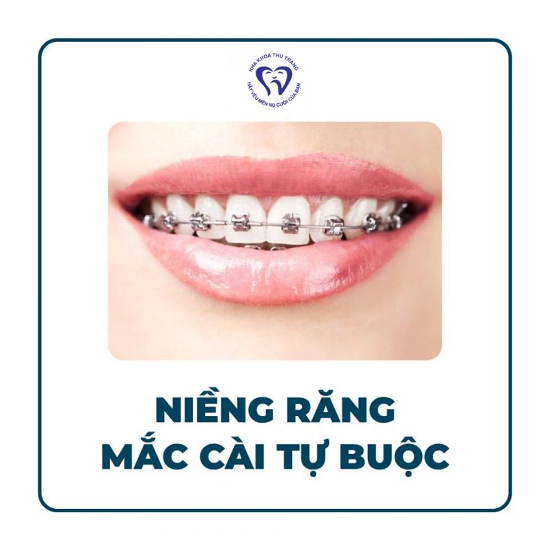 Lựa chọn loại mắc cài nào phù hợp ?
