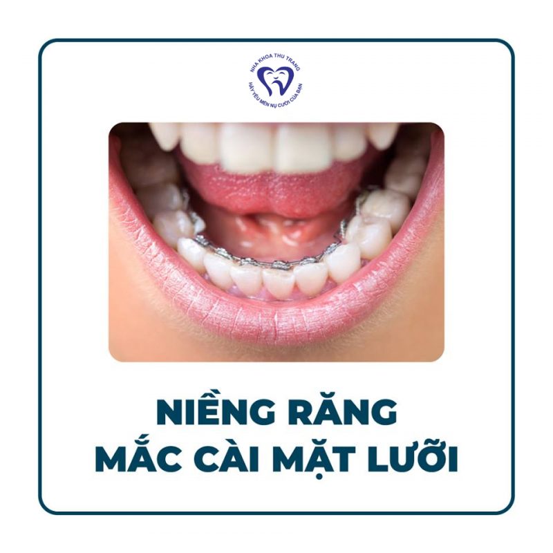 Lựa chọn loại mắc cài nào phù hợp ?