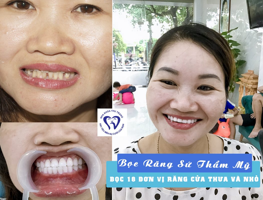Bọc răng sứ thẩm mỹ đẹp tại chương mỹ