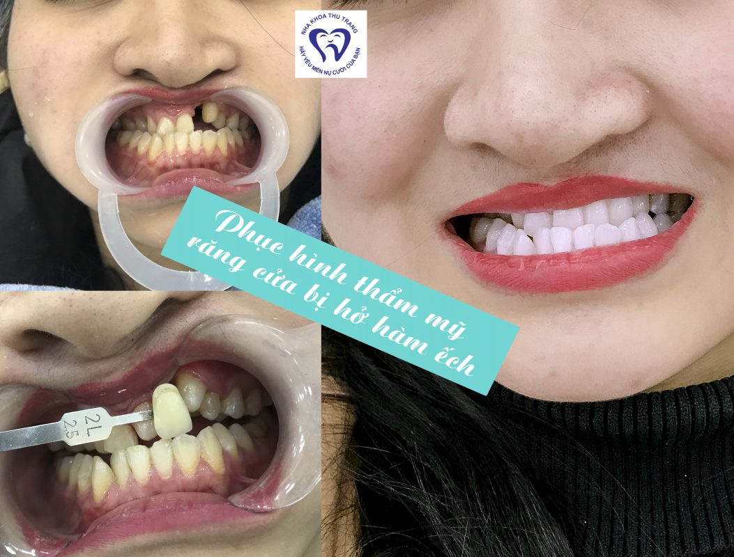 Phục hình thẩm mỹ tại Nha Khoa Thu Trang
