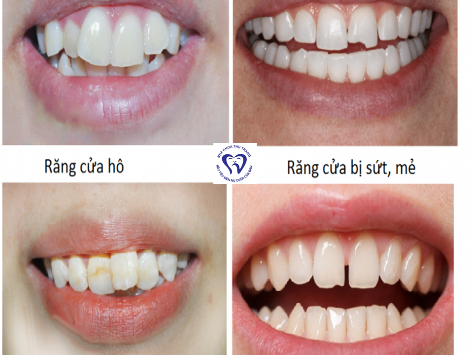 Bọc răng sứ có bền không?