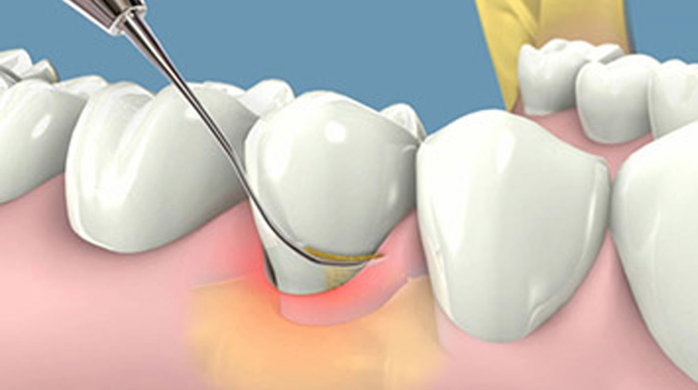Lấy cao răng có ảnh hưởng gì đến răng không?