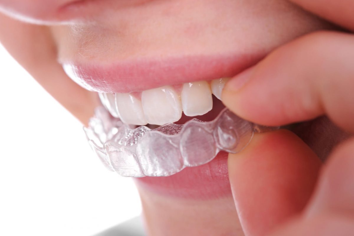 Niềng răng Invisalign tại Nha Khoa Thu Trang.