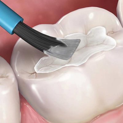 Trám răng bị đen