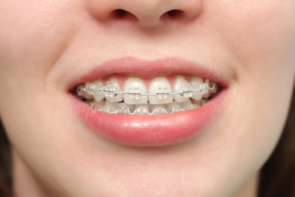 Những câu hỏi liên quan đến chỉnh nha- niềng răng