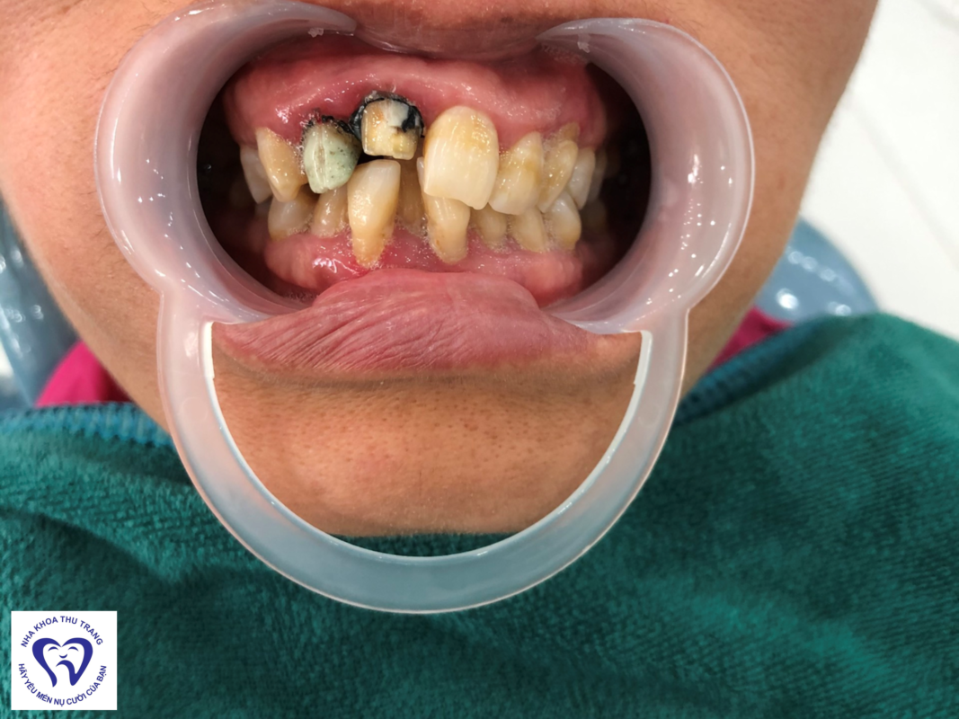 Bọc răng sứ có lợi ích gì?